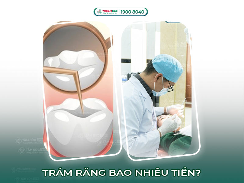 Trám răng sâu lỗ to bao nhiêu tiền? Bảng giá & chất liệu trám tốt nhất