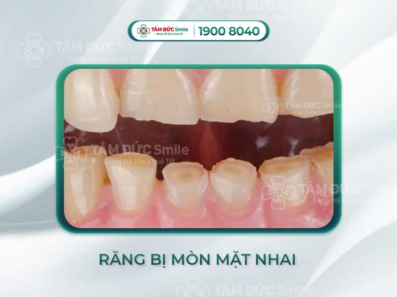 Răng bị mòn mặt nhai: Nguyên nhân, biểu hiện và cách điều trị phục hồi hiệu quả