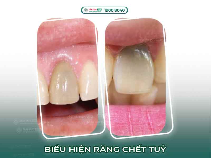 Răng chết tủy là gì? Nguyên nhân, triệu chứng và cách điều trị hiệu quả nhất
