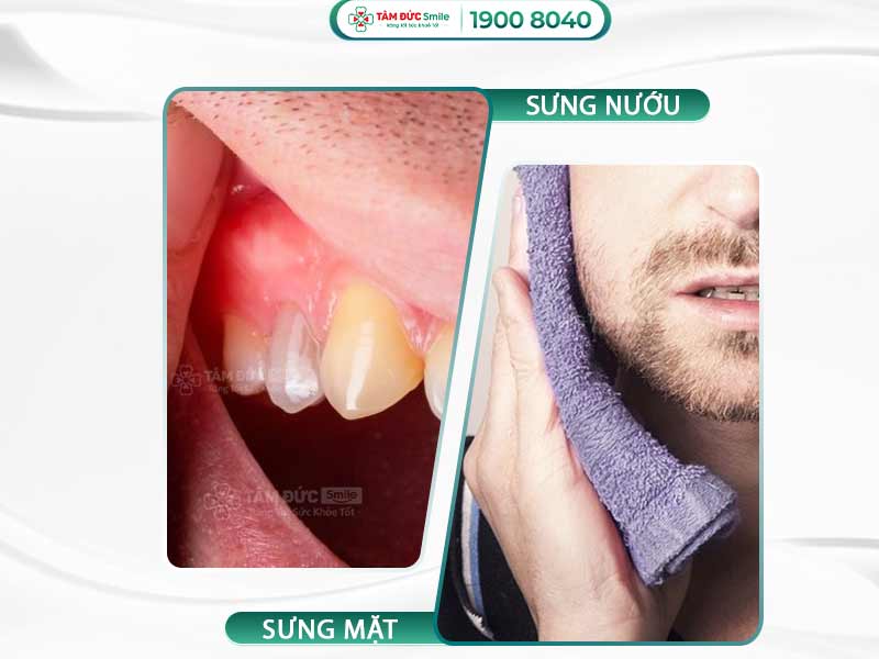 Sưng nướu răng, viêm nướu, đau nướu răng: Giải pháp từ Tâm Đức Smile