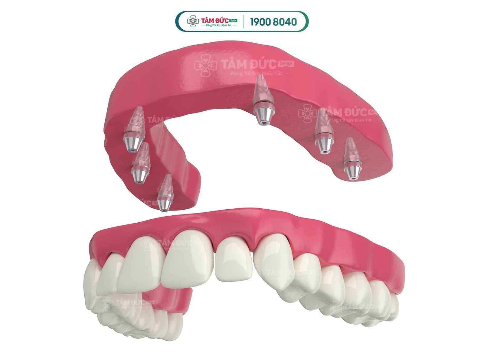 Hàm chỉnh nha tháo lắp – Giải pháp linh hoạt cho răng lệch nhẹ, dễ tháo gỡ