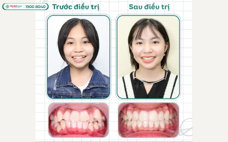 Niềng răng thẩm mỹ tại Nha khoa Tâm Đức Smile với bác sĩ giỏi, công nghệ 3D