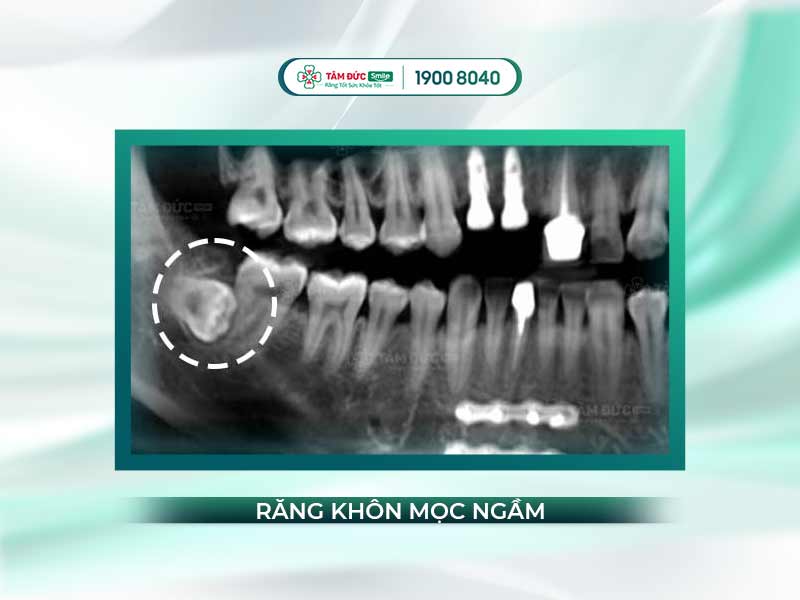 Răng khôn mọc ngầm: Nguyên nhân, biến chứng và cách xử lý an toàn, không đau