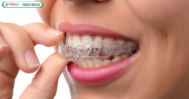 Hướng dẫn chăm sóc răng sau khi niềng, đeo hàm duy trì – Tư vấn từ Tâm Đức Smile