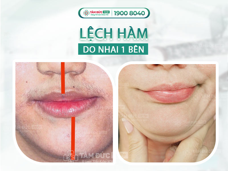 Niềng răng, phẫu thuật lệch hàm tại Nha khoa Tâm Đức Smile – Chỉnh khớp cắn, cân đối gương mặt