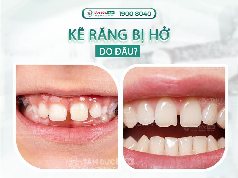 Kẽ răng bị hở: Nguyên nhân, dấu hiệu và cách khắc phục hiệu quả từ chuyên gia