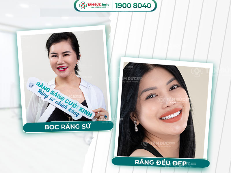 Răng hạt bắp – Bí quyết sở hữu nụ cười chuẩn Hàn, răng đều tăm tắp tự nhiên