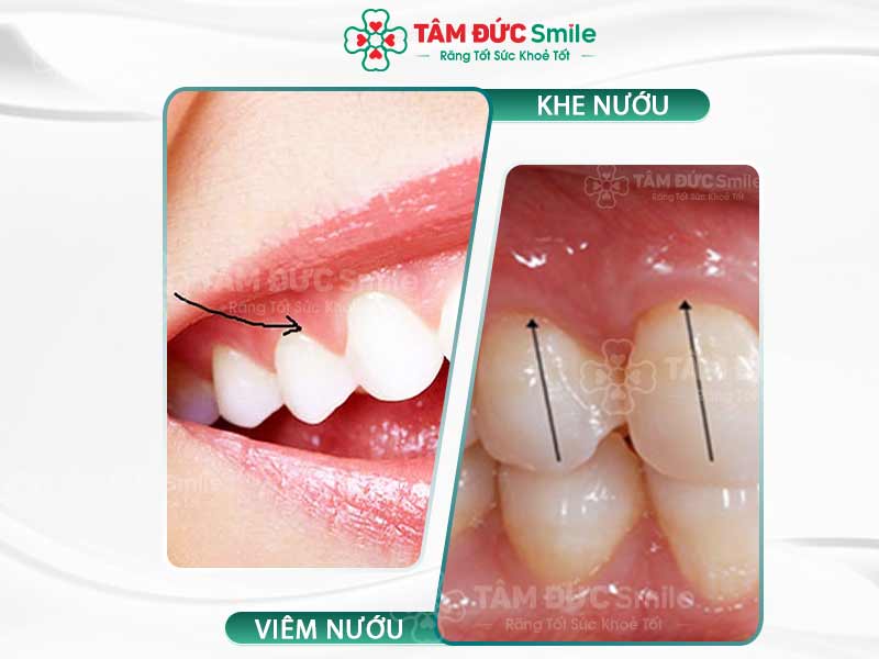 Khe nướu là gì? Nguyên nhân – Biến chứng – Cách điều trị tại Nha khoa Tâm Đức Smile