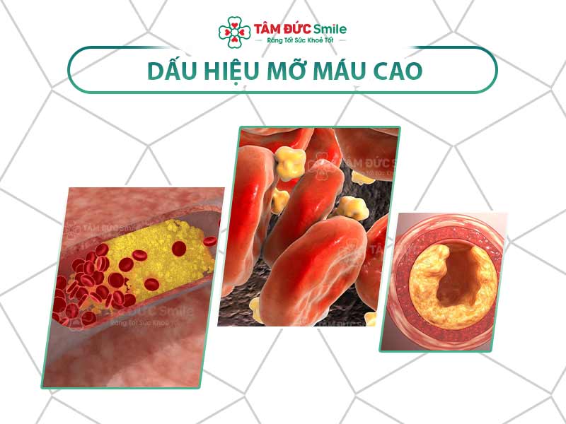 Mỡ máu cao: Nguyên nhân, chỉ số nguy hiểm và cách điều trị hiệu quả an toàn