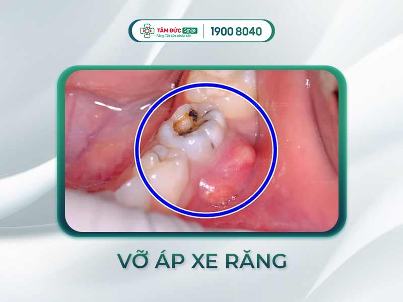Điều trị vỡ áp xe răng: Nguyên nhân, triệu chứng và phương pháp chữa trị