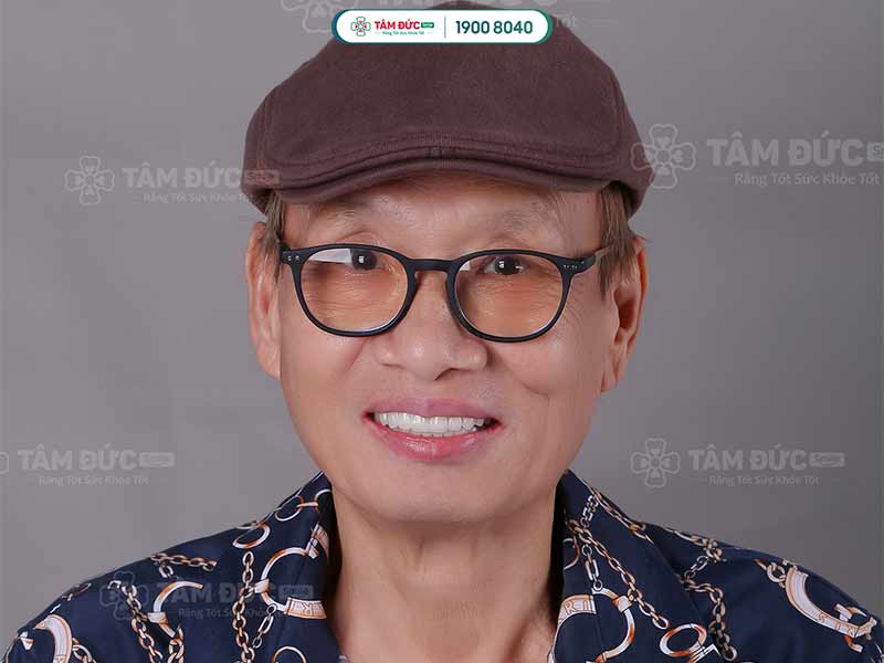 Răng giả tháo lắp giá bao nhiêu? Bảng giá và ưu đãi tại Nha khoa Tâm Đức Smile