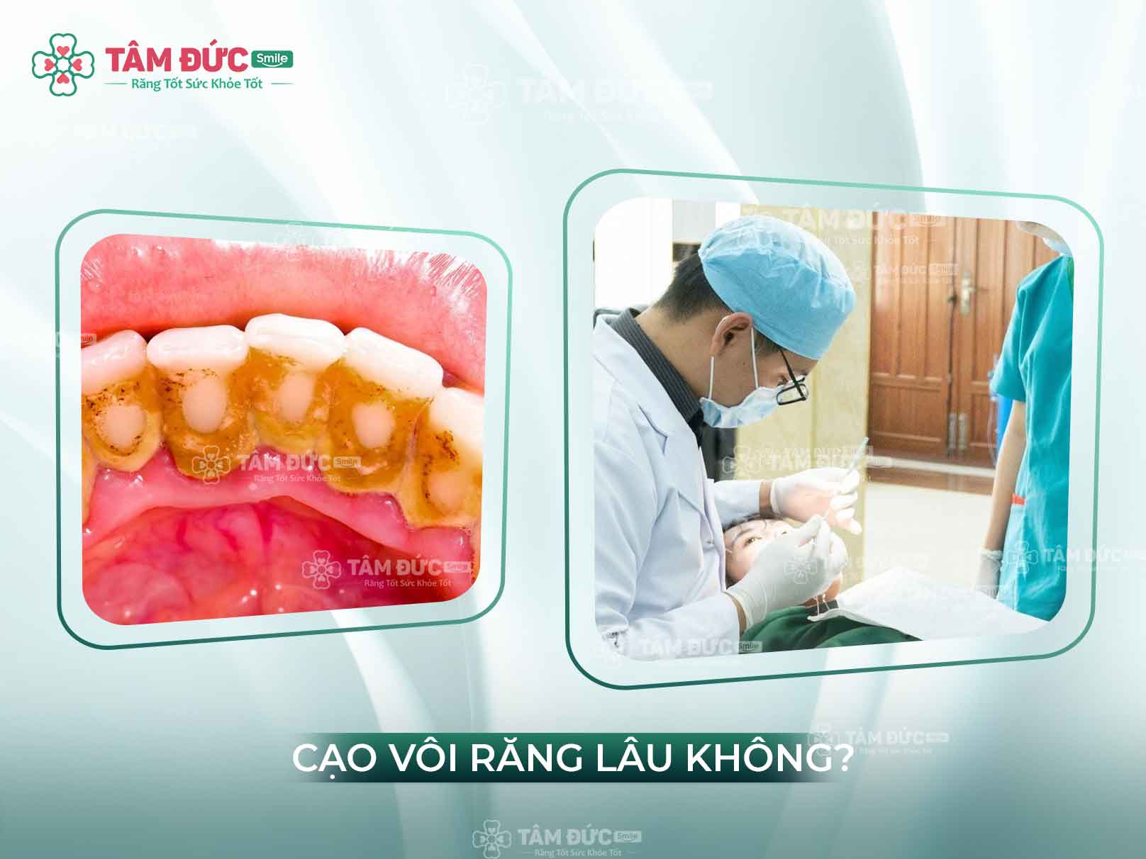 Lấy cao răng mất bao lâu? Quy trình – thời gian – cảm giác tại Nha khoa Tâm Đức Smile