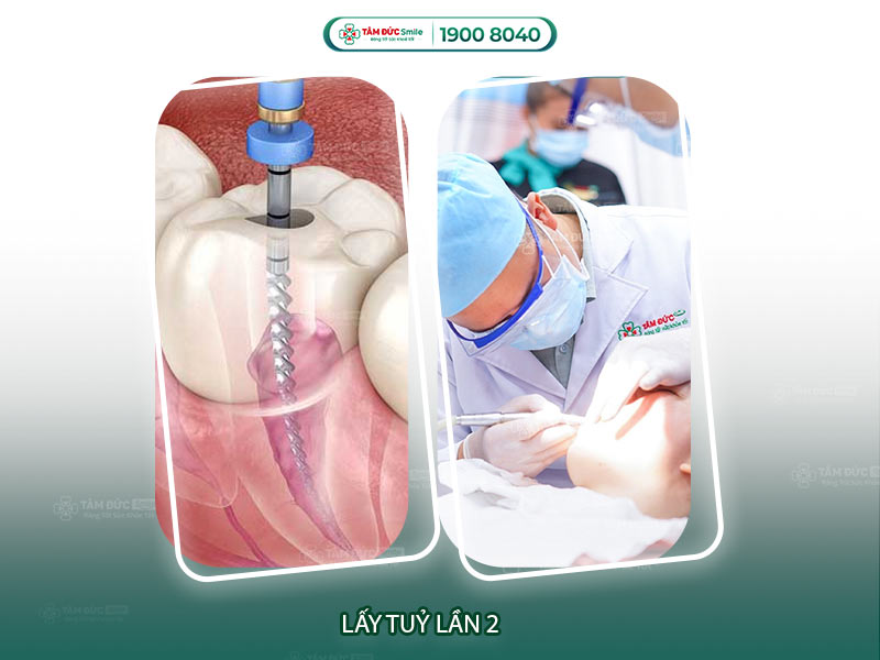 Lấy tủy răng lần 2 có đau không? Nguyên nhân – mức độ – cách giảm đau hiệu quả