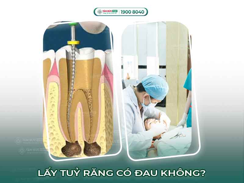 Lấy tủy răng có đau không? Giải đáp quy trình, chi phí và cách giảm đau hiệu quả