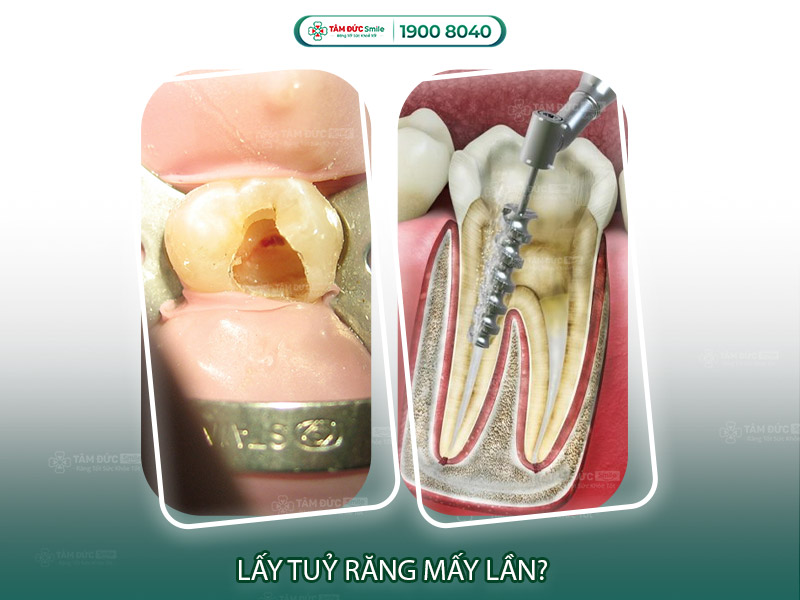 Lấy tủy răng mấy lần mới xong? Quy trình – thời gian – khi nào cần điều trị nhiều lần