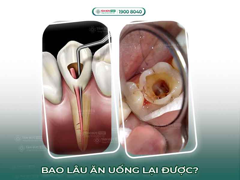 Lấy tủy răng bao lâu thì ăn được? Hướng dẫn phục hồi sau khi lấy tủy