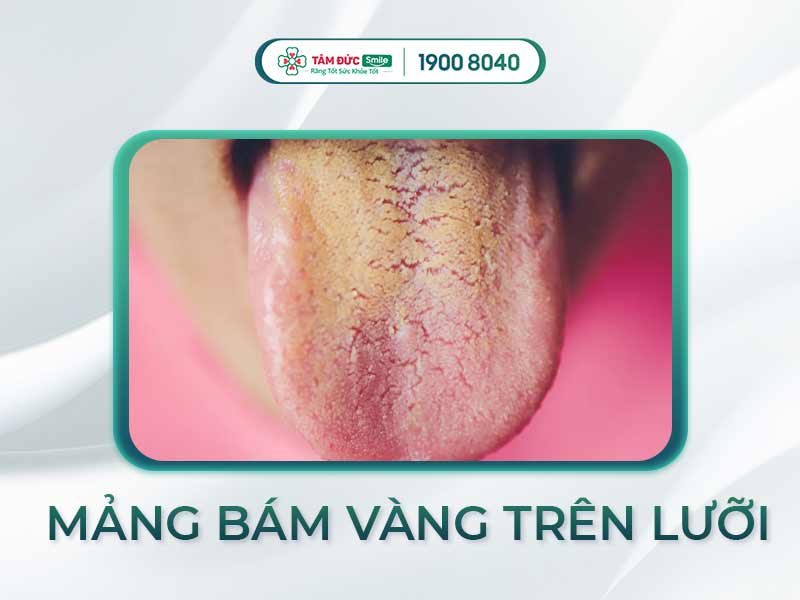 Lưỡi có mảng bám màu vàng: Nguyên nhân, dấu hiệu và cách làm sạch hiệu quả