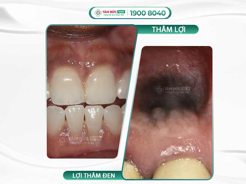 Lợi thâm đen: Nguyên nhân phổ biến và cách khắc phục hiệu quả tại nhà