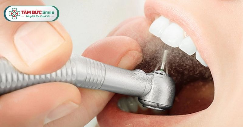 Mài răng có đau không? Quy trình – chi phí – rủi ro & công nghệ an toàn mới nhất