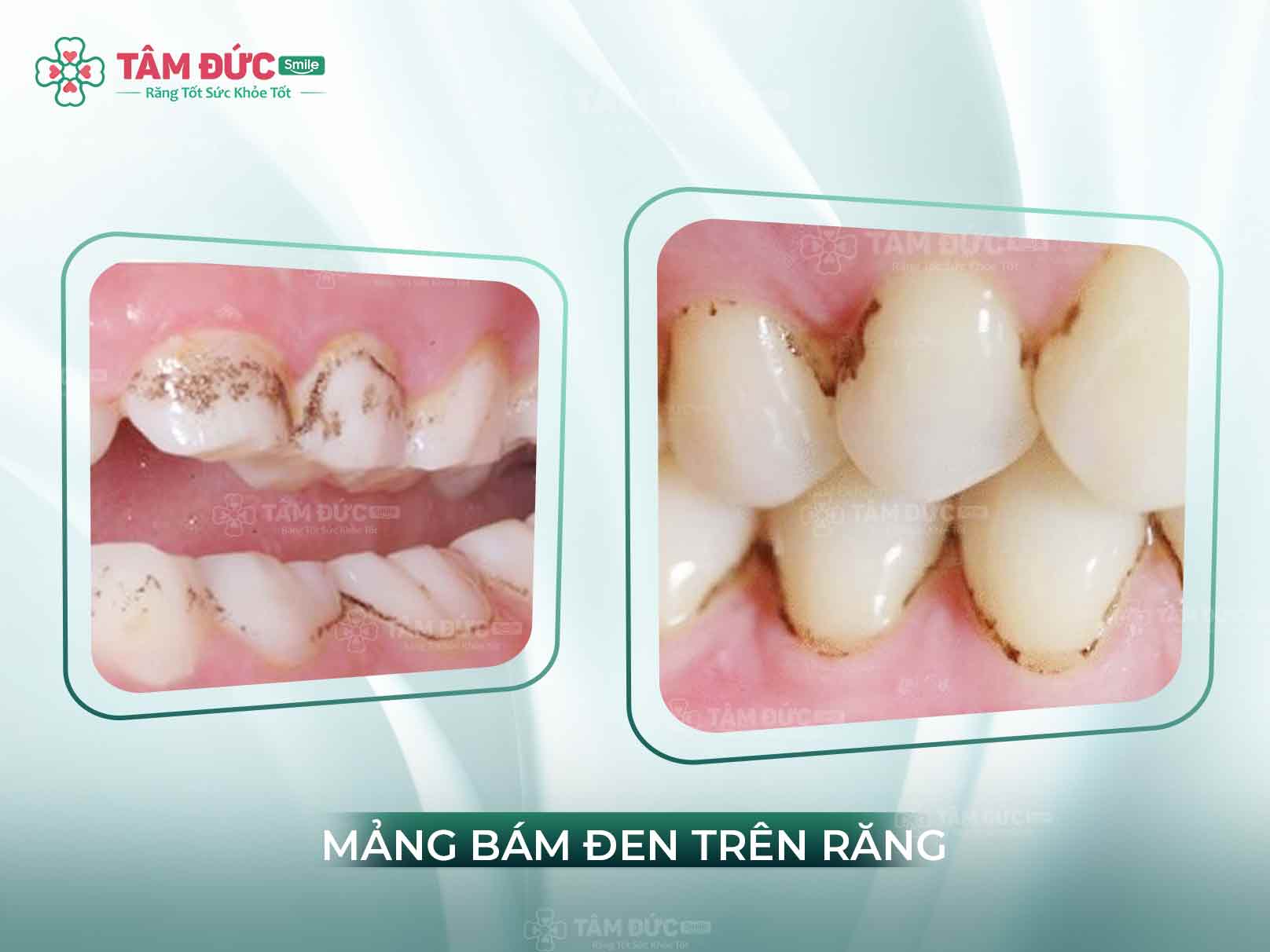 Mảng bám đen trên răng là gì? Nguyên nhân và cách xử lý hiệu quả tại nha khoa