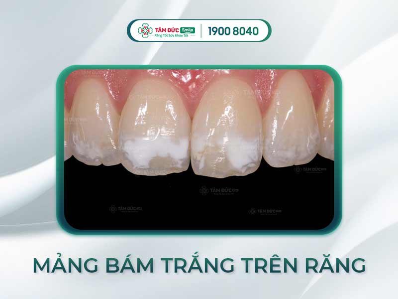 Mảng bám trên răng: Nguyên nhân, tác hại và cách xử lý hiệu quả tại nhà