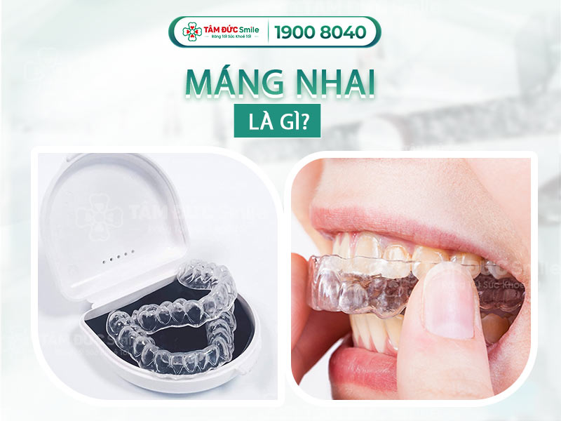 Máng nhai chống nghiến răng tại Nha khoa Tâm Đức Smile – Thiết kế theo dấu răng