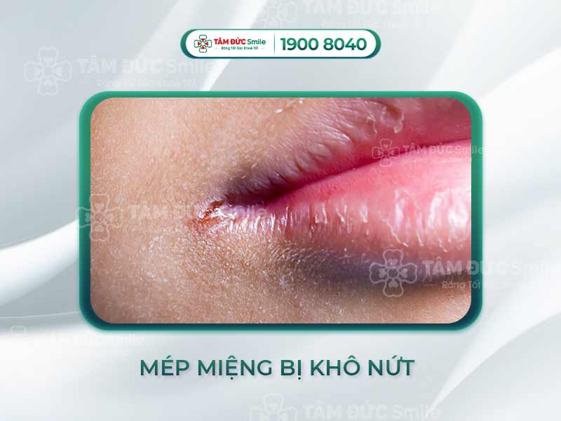 Mép miệng bị khô nứt: Nguyên nhân, cách điều trị và phòng ngừa hiệu quả nhất