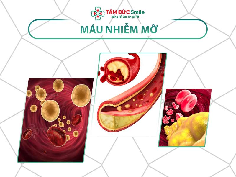 Mỡ máu là gì? Nguyên nhân, dấu hiệu và cách điều trị hiệu quả an toàn