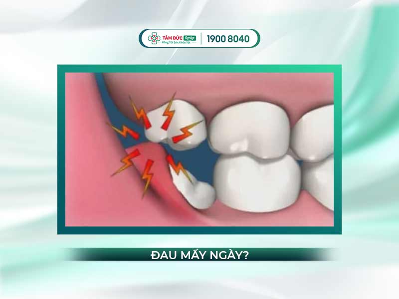 Mọc răng khôn đau mấy ngày? Giảm đau, nhổ răng khôn lệch tại Tâm Đức Smile