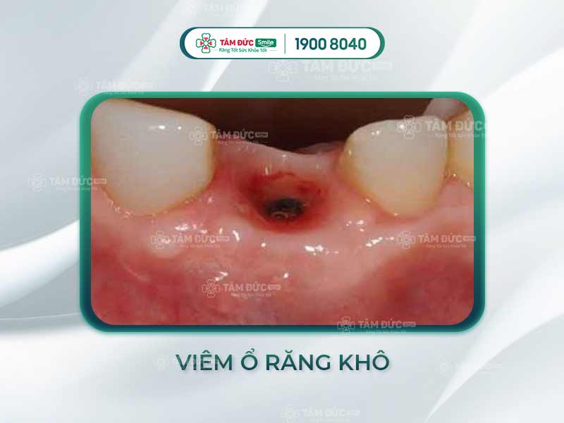 Viêm ổ răng khô: Triệu chứng, nguyên nhân và điều trị