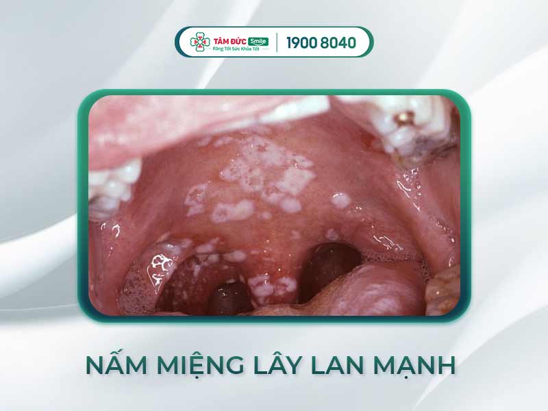 Nấm miệng có lây không? Nguyên nhân, dấu hiệu và cách điều trị hiệu quả