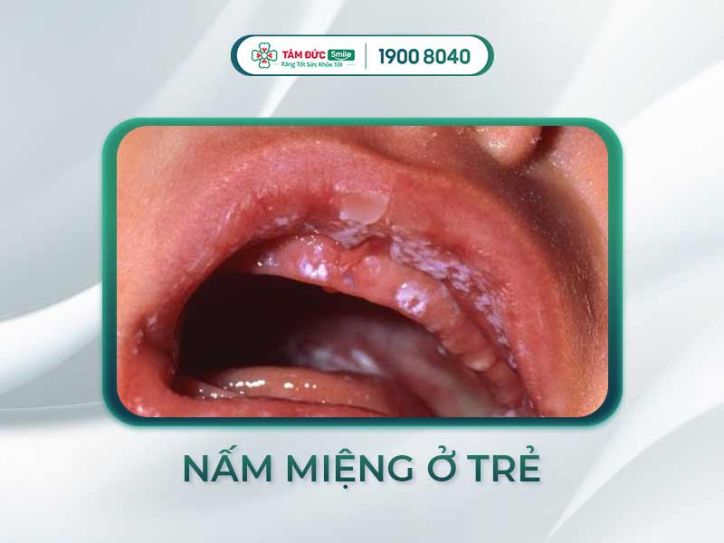 Dấu hiệu, nguyên nhân và cách chữa nấm miệng ở trẻ 2 tuổi cha mẹ cần biết