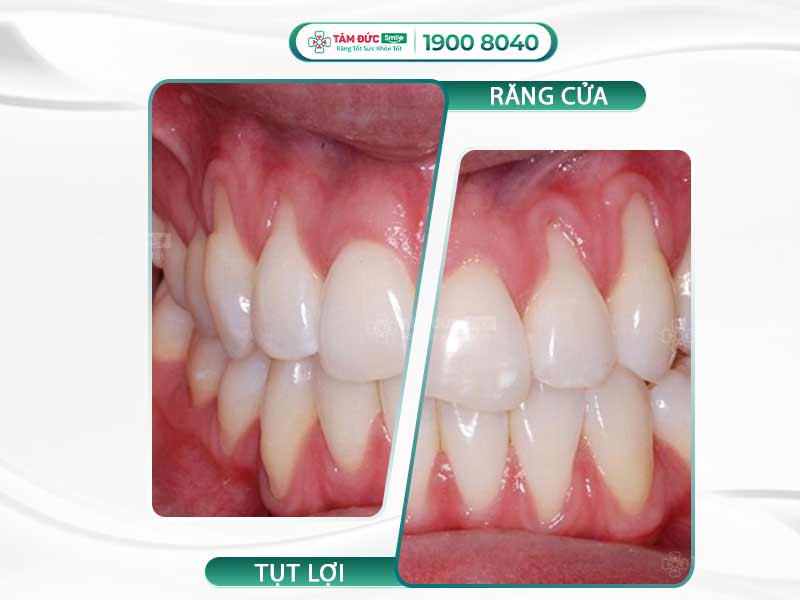 Răng cửa bị tụt lợi: Nguyên nhân, cách điều trị và chi phí tại Nha khoa Tâm Đức Smile