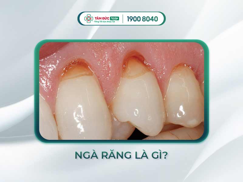 Ngà răng là gì? Dấu hiệu, nguyên nhân và cách phục hồi ngà răng tại Tâm Đức Smile