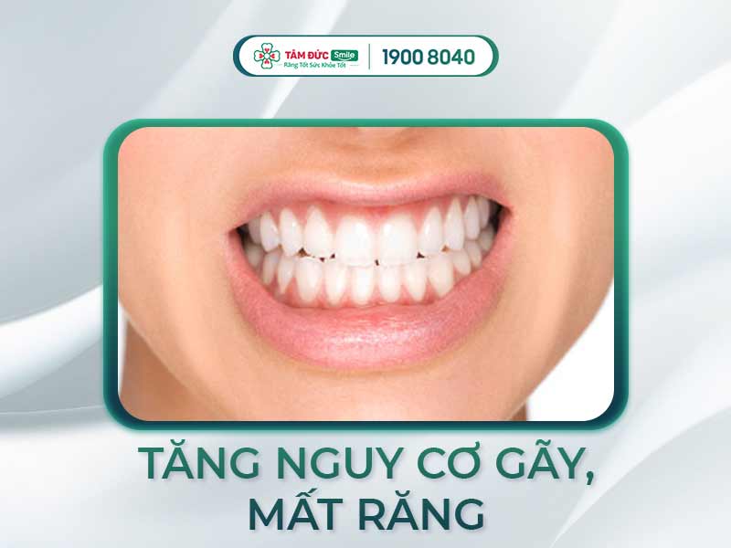 Nghiến răng là gì? Nguyên nhân, triệu chứng và cách điều trị