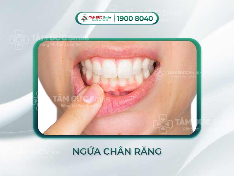 Ngứa chân răng là dấu hiệu của bệnh gì? Viêm lợi, tụt lợi hay viêm nha chu?