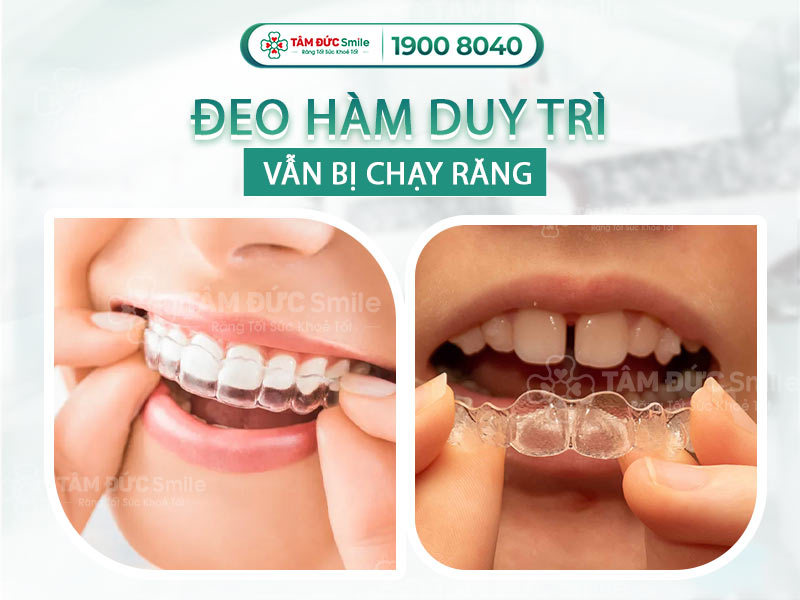 Răng bị xô lệch dù đeo hàm duy trì: Nguyên nhân, sai lầm và cách khắc phục