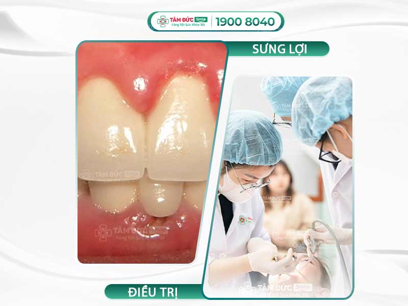 Sưng lợi răng cửa: Nguyên nhân, dấu hiệu và cách điều trị hiệu quả nhất