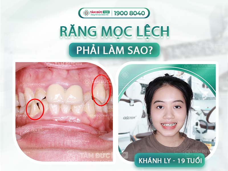 Răng nanh mọc lệch: Nguyên nhân, ảnh hưởng và cách điều trị hiệu quả nhất