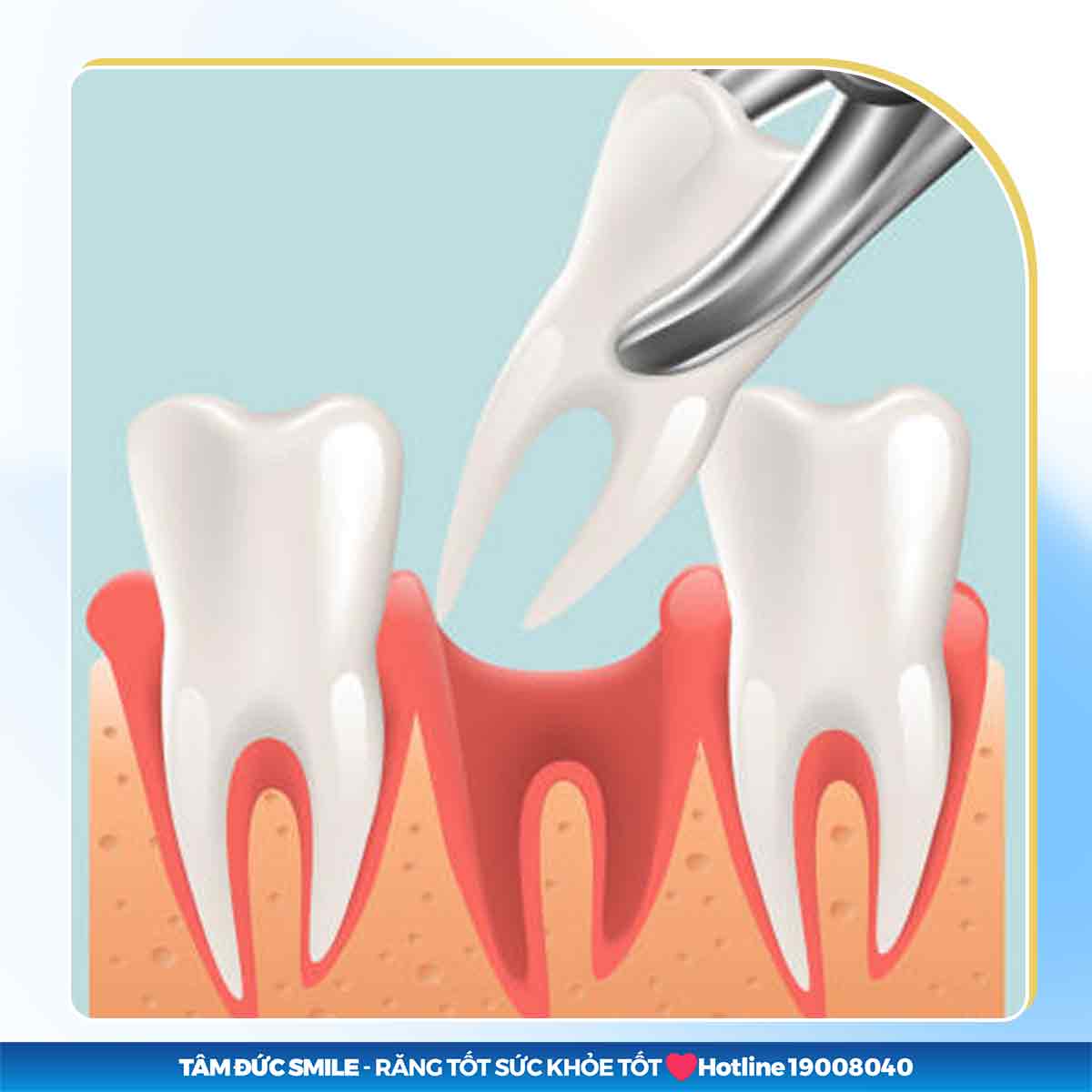 Nhổ răng cấm có cần phải trồng lại không? Giải đáp & phương án khắc phục