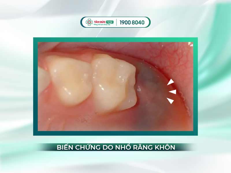 Nhổ răng khôn 2 tuần vẫn đau: Nguyên nhân, biến chứng và cách xử lý hiệu quả