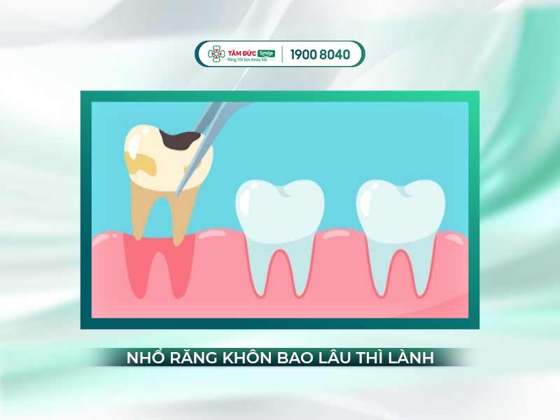 Nhổ răng khôn bao lâu thì lành? Hết sưng, hết đau, ăn cơm lại sau mấy ngày?