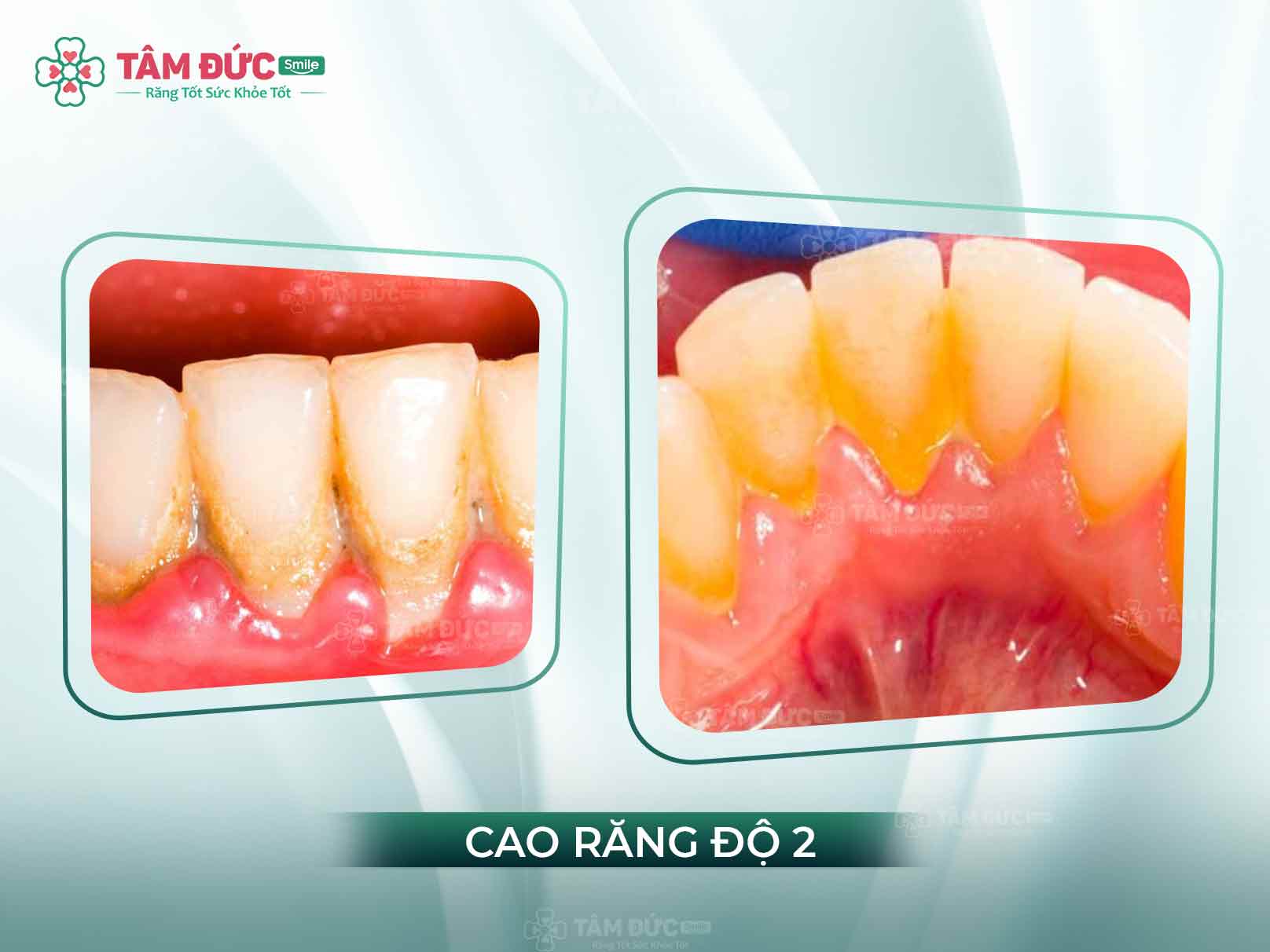 Cao răng cấp độ 2 là gì? Dấu hiệu, hậu quả và cách điều trị hiệu quả nhất