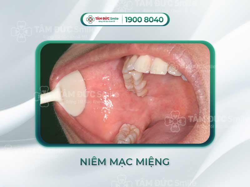 Niêm mạc là gì? Cấu trúc, chức năng và dấu hiệu viêm loét thường gặp