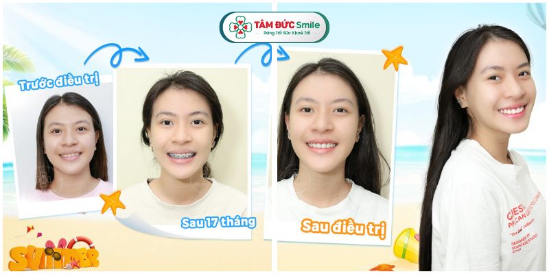 nieng-rang-1-ham-gia-bao-nhieu-tien-6