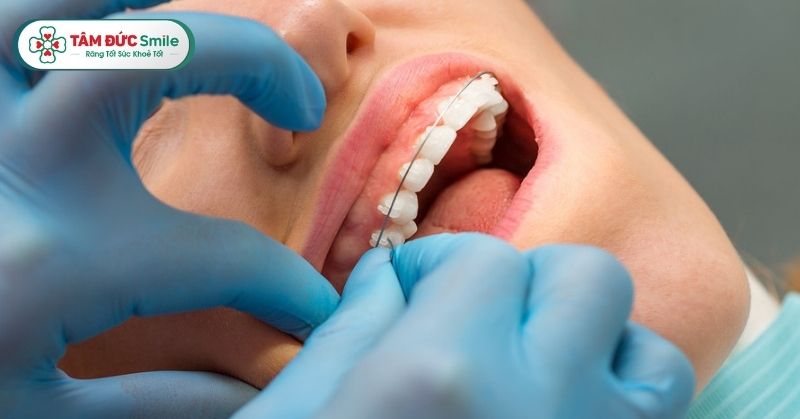 Niềng răng 1 hàm giá bao nhiêu tiền? Bảng giá chi tiết tại Nha khoa Tâm Đức Smile