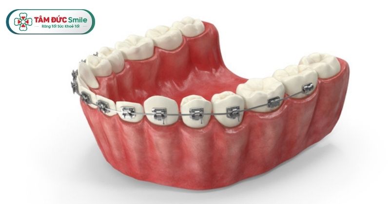 Niềng răng hàm dưới giá bao nhiêu? Bảng giá ưu đãi tại Nha khoa Tâm Đức Smile