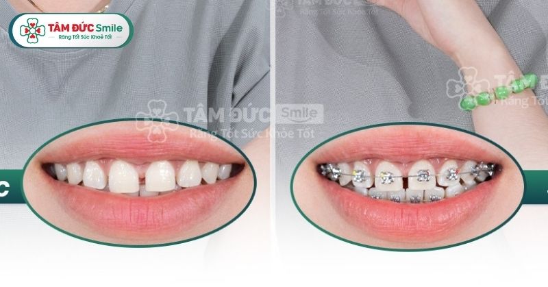 Niềng răng thưa giá rẻ, không đau, trả góp 0% tại Nha khoa Tâm Đức Smile