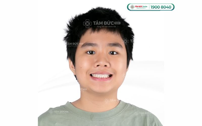 nieng-rang-tre-em-gia-bao-nhieu-1