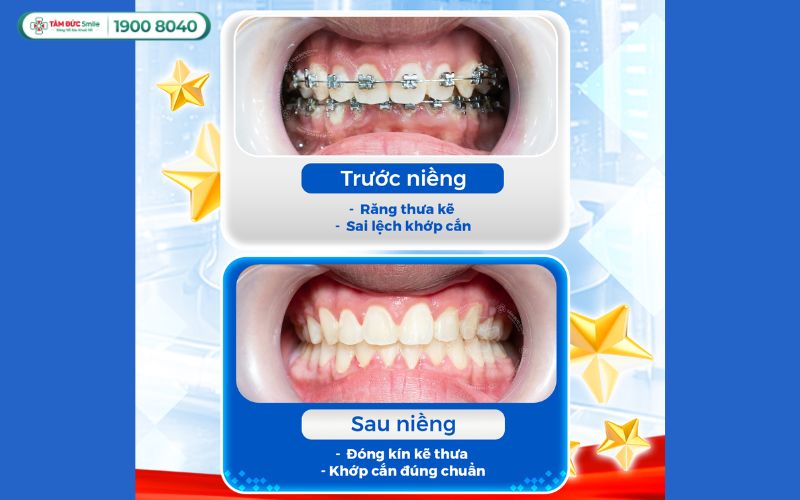 nieng-rang-tre-em-gia-bao-nhieu-2